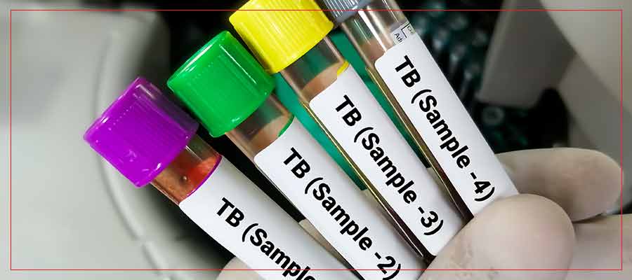 TB Testing Clinic Near Me in Crown Point, IN