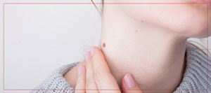 Warts Removal Services Near Me in Crown Point, IN