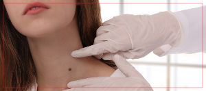 What Causes Skin Tags? | Mullally Sports & Family Medicine Near Me in Crown Point, IN What Causes Skin Tags? | Mullally Sports & Family Medicine Near Me in Crown Point, IN