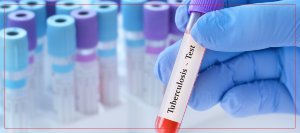 Where to Get a TB Test Near Me in Crown Point, IN Where to Get a TB Test Near Me in Crown Point, IN
