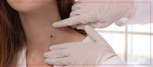 How Much Does Skin Tag Removal Cost Without Insurance? | Mullally Sports & Family Medicine in Crown Point, IN